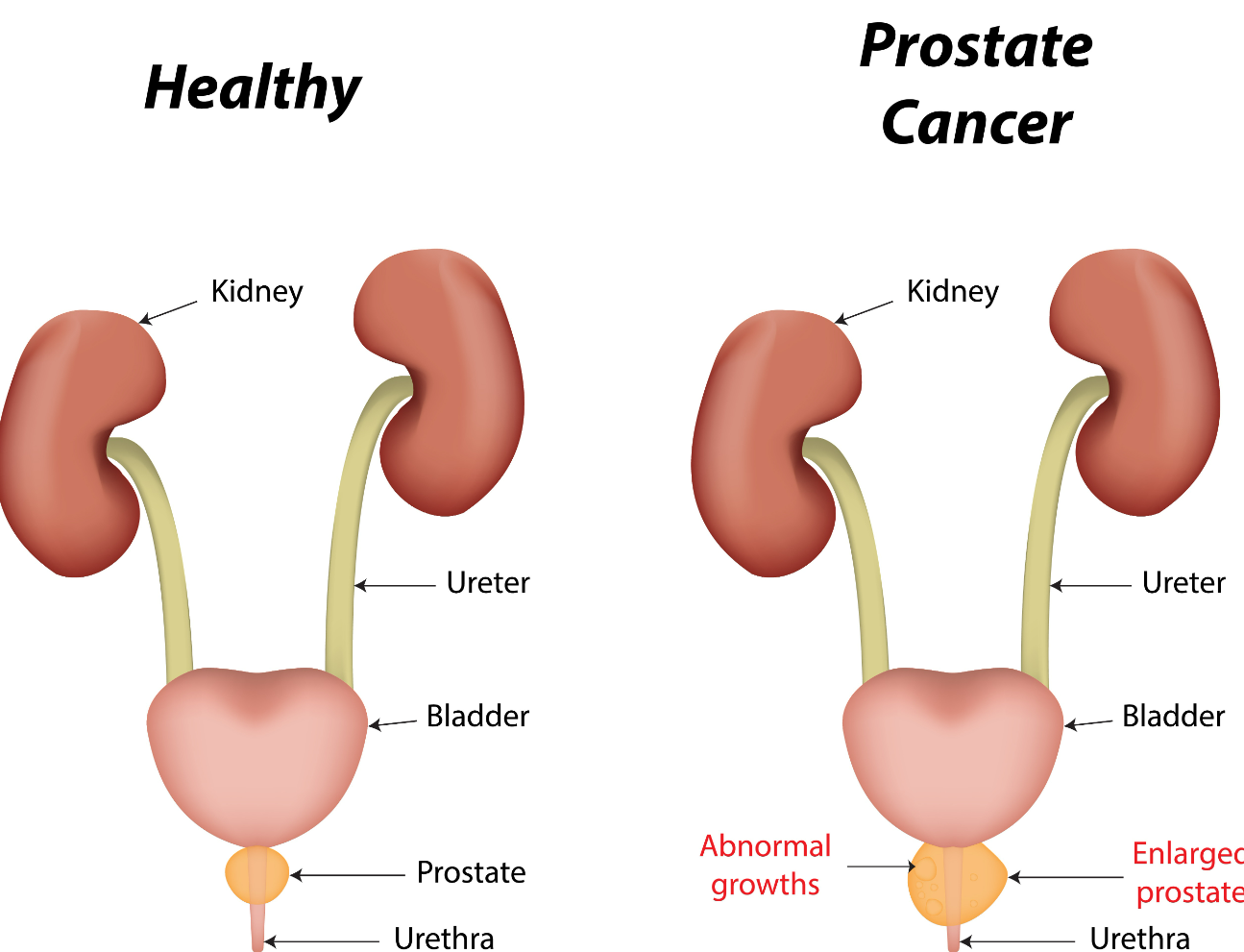 Mens Health: Prostate Cancer Side Effects, Prevention and Cure