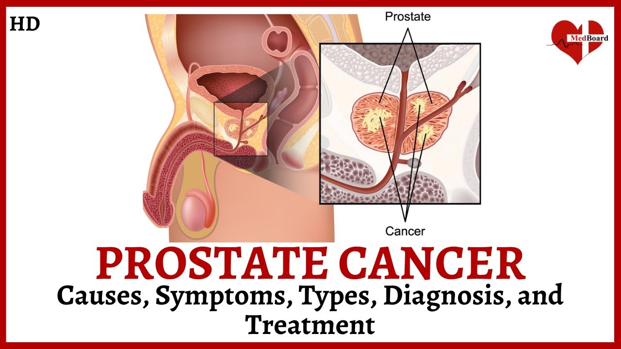 Prostate Cancer: What is It?  What Causes Is, Types, Symptoms, Diagnosis and Treatment